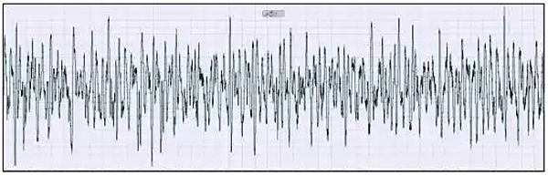 Figure 1 Vortex-shedding signal from a semi-water gas main under vibration interference